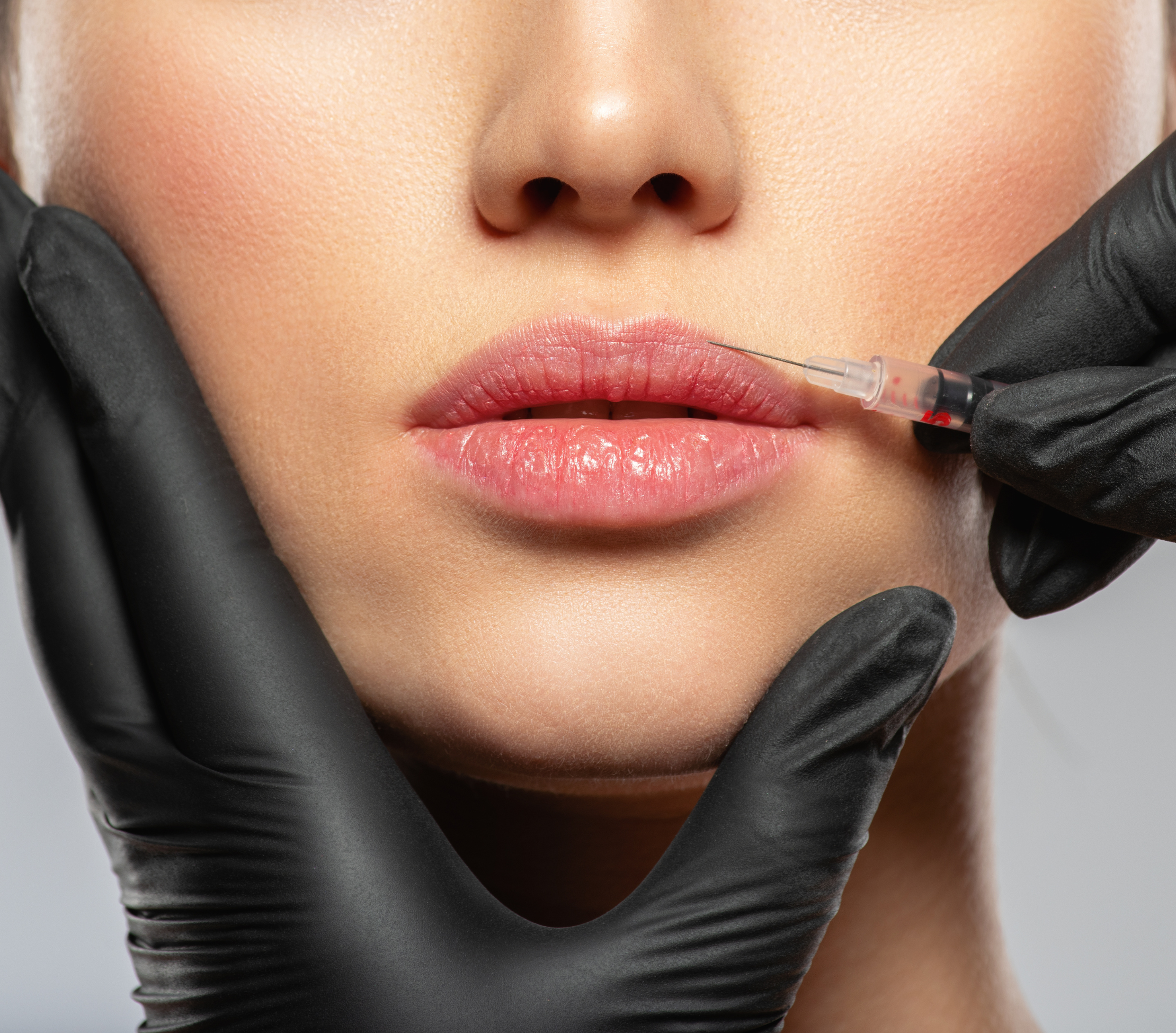Lip Enhancement with Dermal Fillers