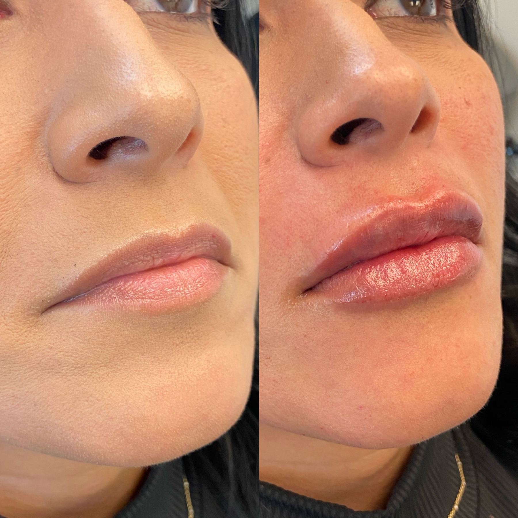 Chin Dimpling