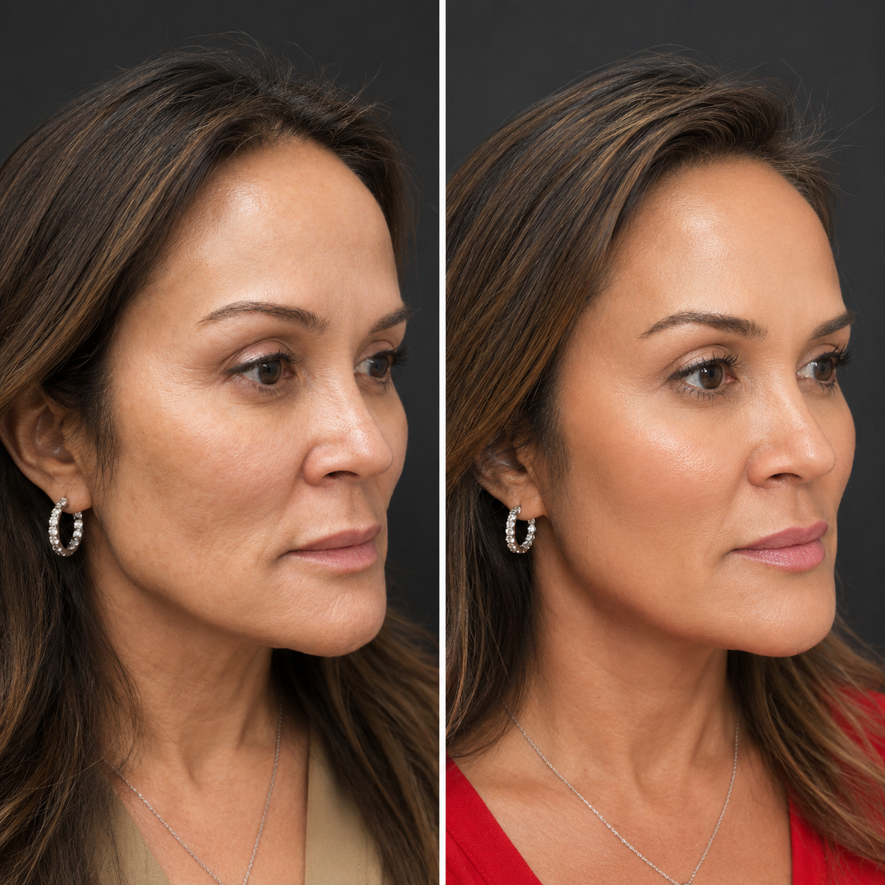 Facial Balancing with Dermal Fillers