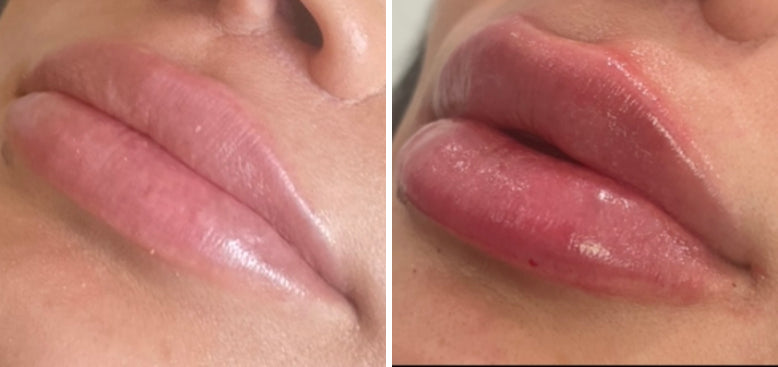 Lip Enhancement (filler)
