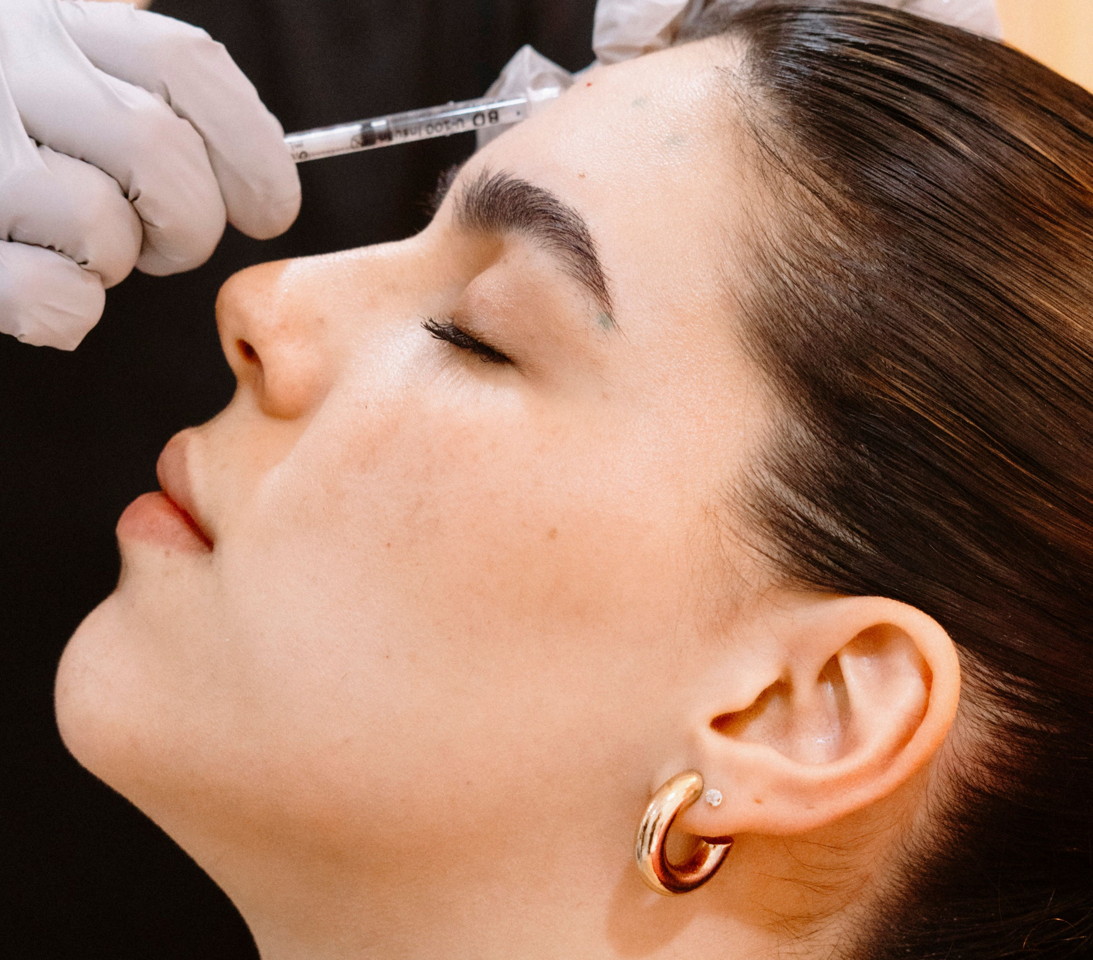 Botulinum Toxin – Full Upper Face
