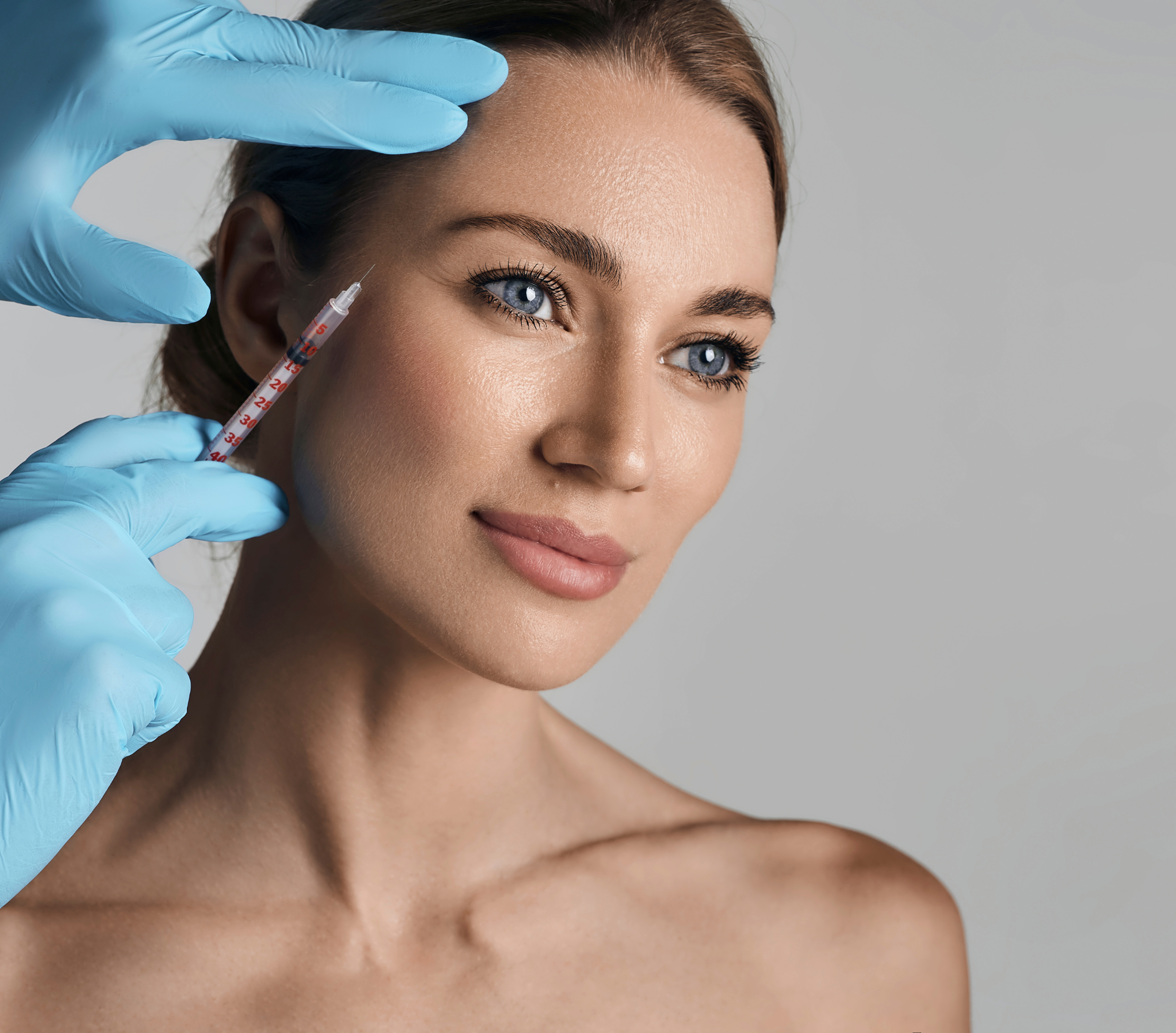 Botulinum toxin - Crow's feet