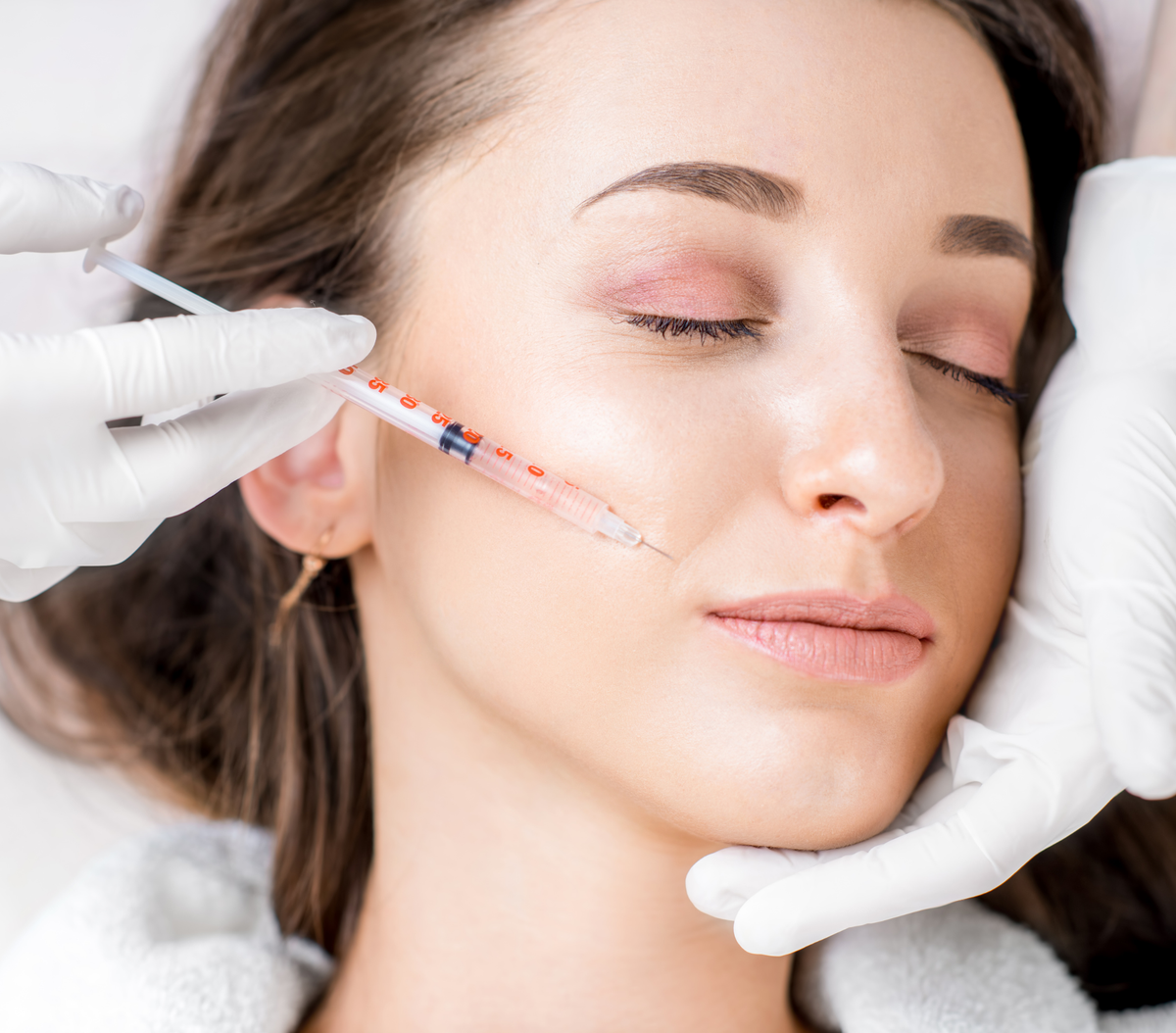 Smile Lines (Nasolabial folds)