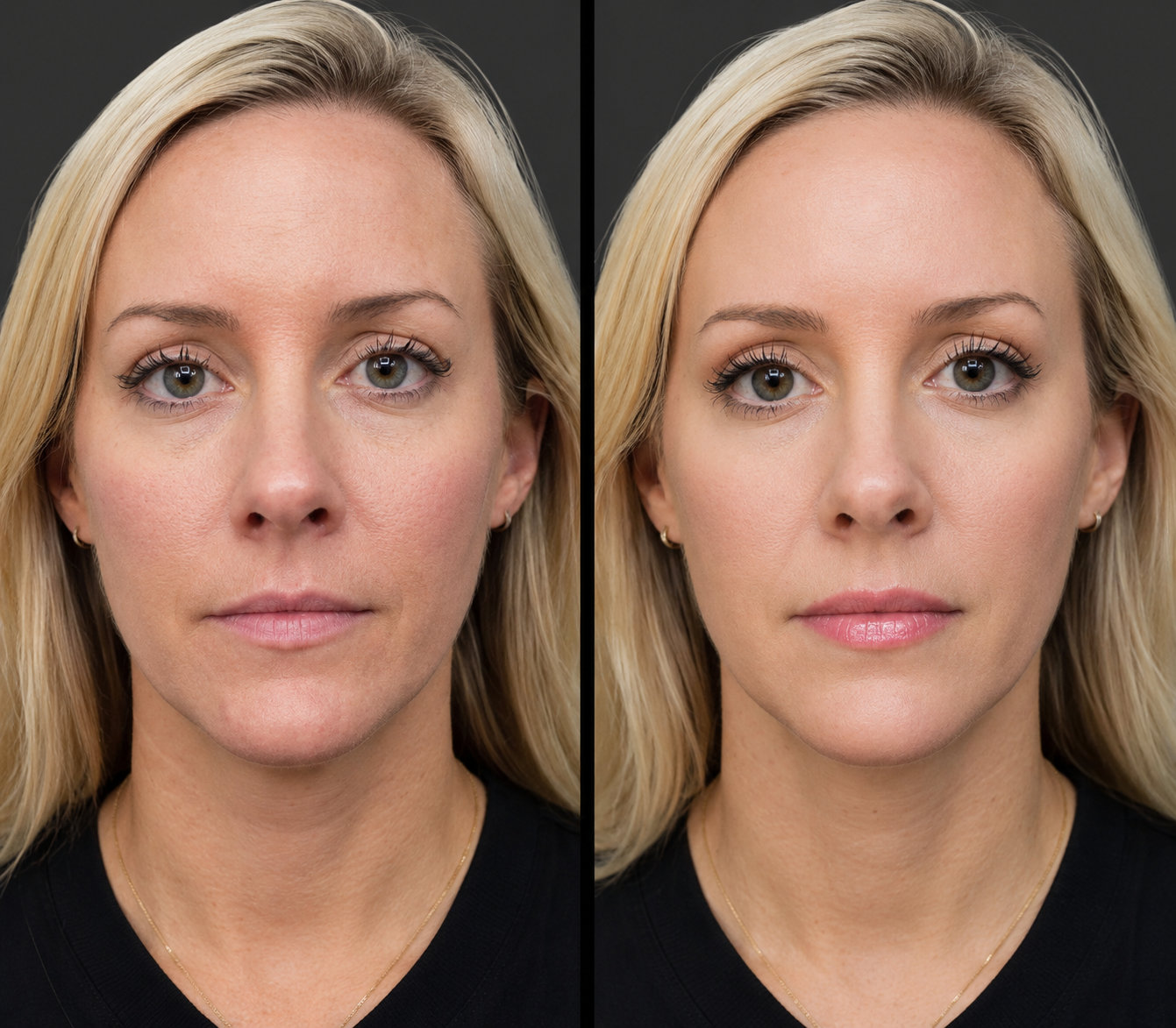 Cheek Contouring with Dermal Fillers