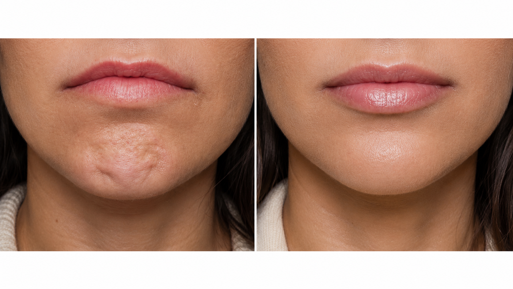 Chin Dimpling (Botulinum)