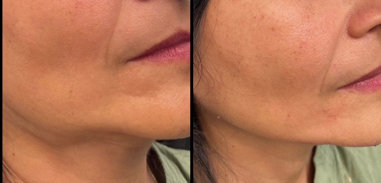 Jawline Contouring with Dermal Fillers and Botox