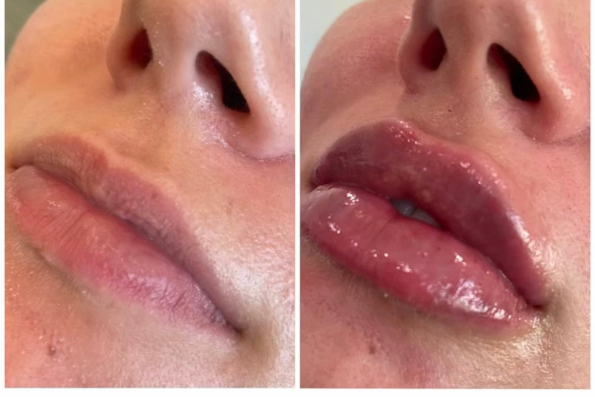 Lip Enhancement (filler)