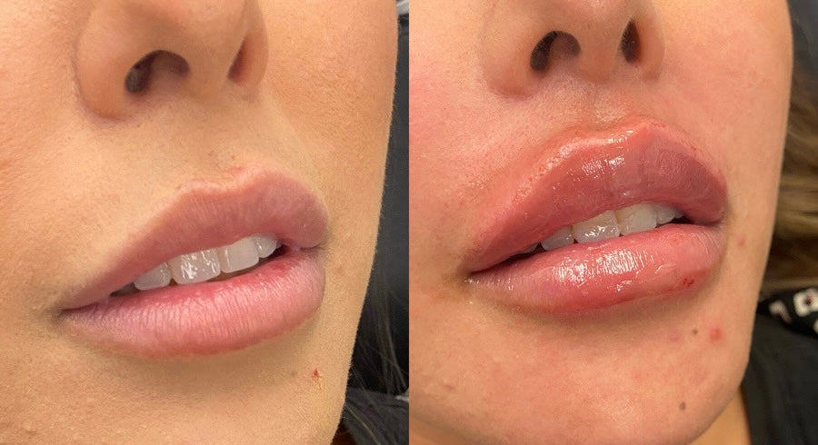 Lip Enhancement with Dermal Fillers