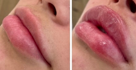 Lip Enhancement (filler)
