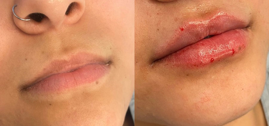 Lip Enhancement with Dermal Fillers