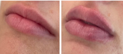 Lip Enhancement with Dermal Fillers