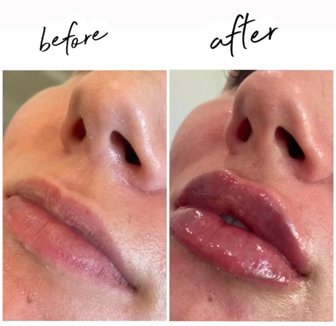 Lip Enhancement with Dermal Fillers