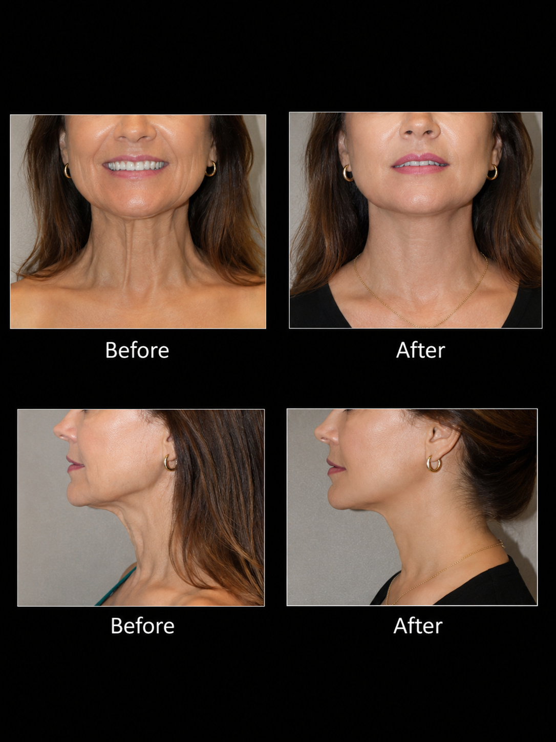 Neck Lift (Nefertiti lift)