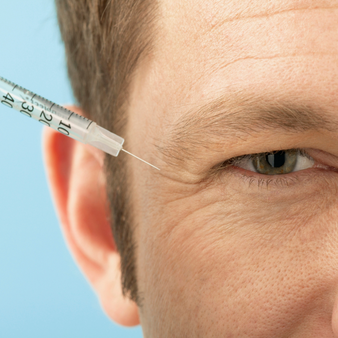 Botulinum toxin - Crow's feet